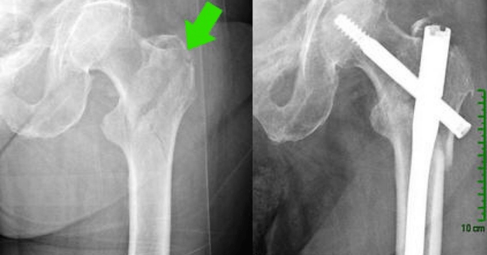 Hip fracture with mrsa cellulitis case study